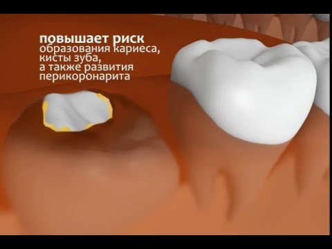 Если прорезается мудрый зуб Если прорезается мудрый зуб