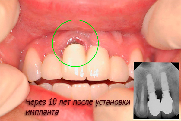 Чего нельзя с имплантом зуба Чего нельзя с имплантом зуба