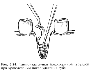 Турунда в зуб что это такое Турунда в зуб что это такое