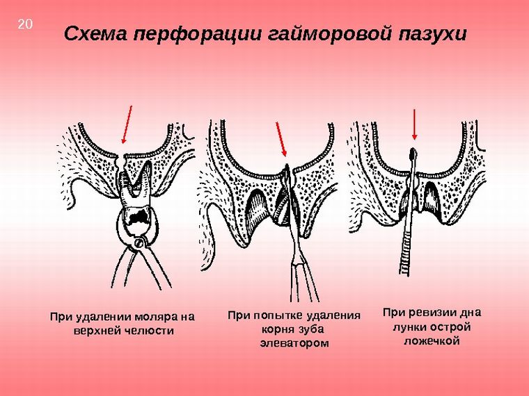 Удалить зуб корни в пазухе Удалить зуб корни в пазухе