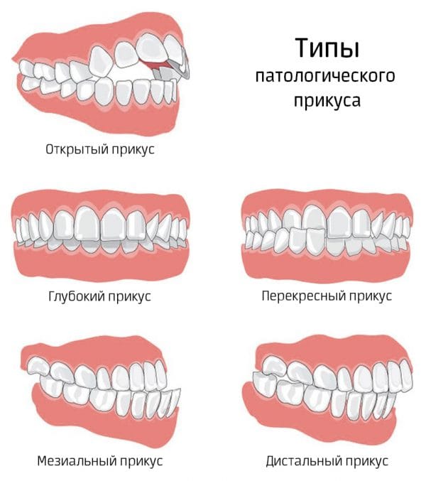 Типы смыкания зубов Типы смыкания зубов