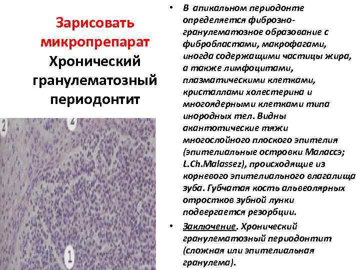 Патологическая анатомия лекции. Апикальный периодонтит патанатомия. Хронический гранулематозный периодонтит патологическая анатомия. Патологическая анатомия хронического гранулирующего периодонтита. Острый серозный периодонтит патологическая анатомия.