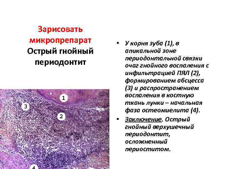 Строение стенки абсцесса