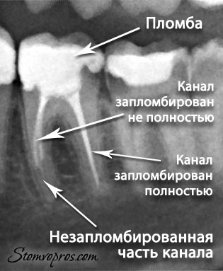 Пломбируют Зуб Фото