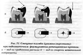 Стенки кариозной полости v класса при пломбированиикомпозитом формируют